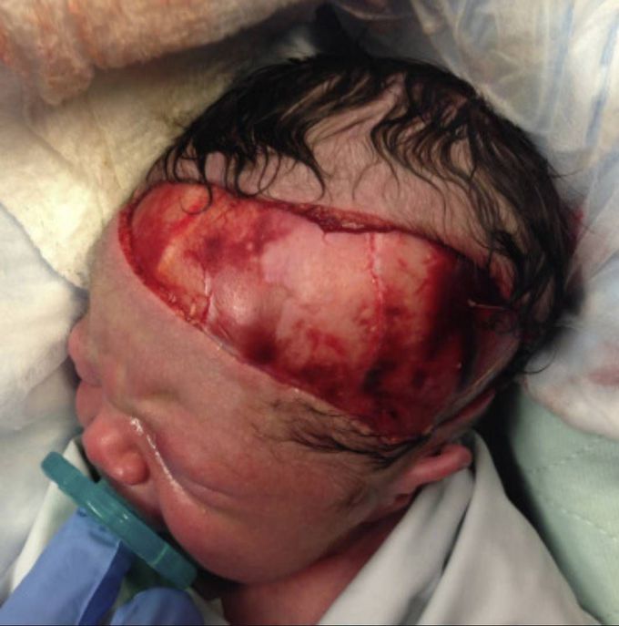 Severe scalp laceration in a newborn due to cesarean section complications! 