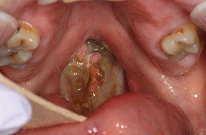 Oxycodone-related Palatal Perforation.