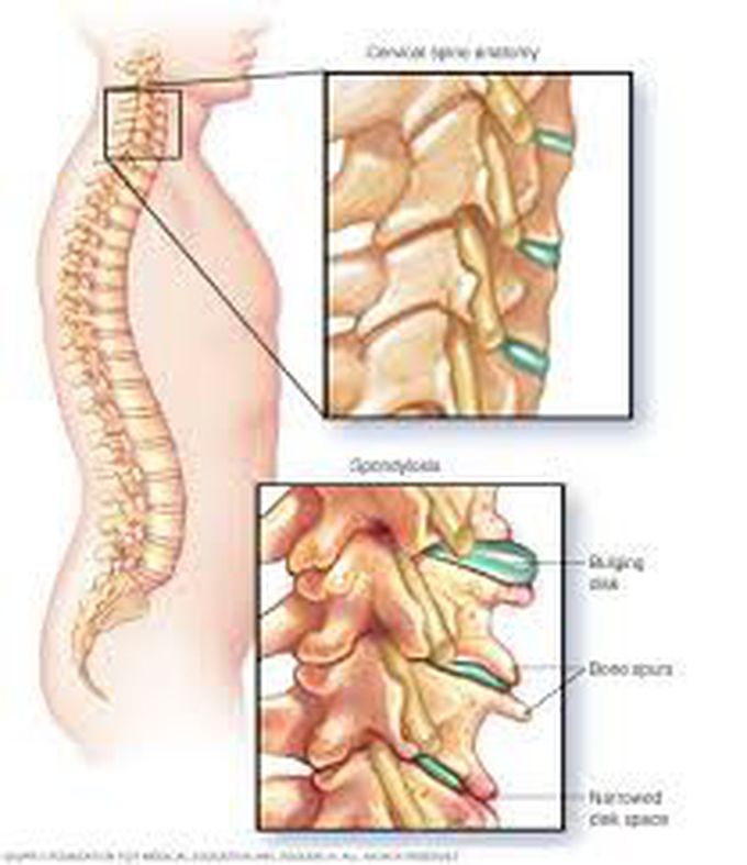 Symptoms of spondylosis