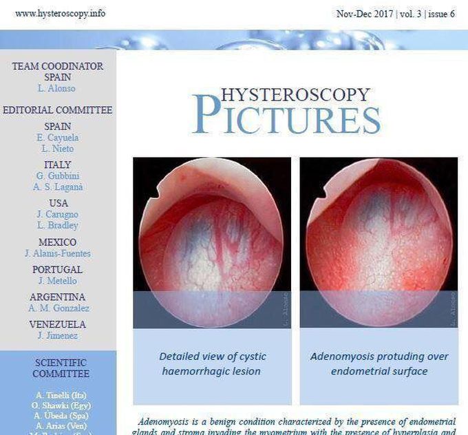 Hysteroscopy