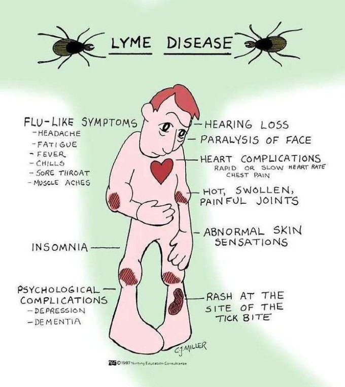 Lyme disease - MEDizzy