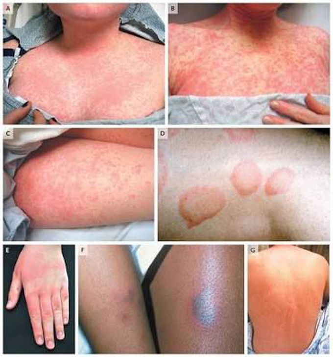 Exanthematous reaction?causes?