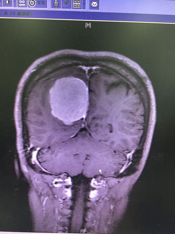 Meningioma