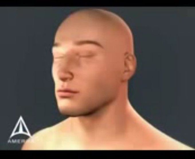 Tracheostomy