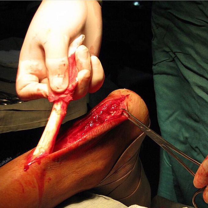 Strongest tendon