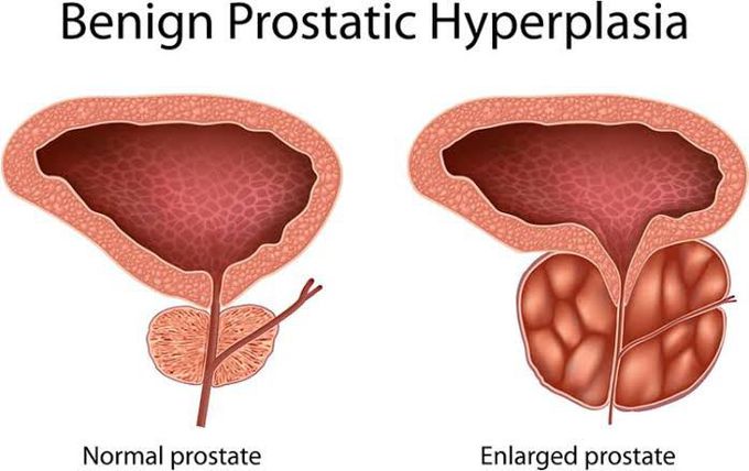 Benign prostate enlargement Treatment