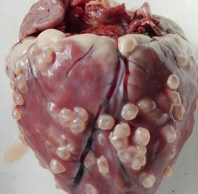 Cardiac cysticercosis