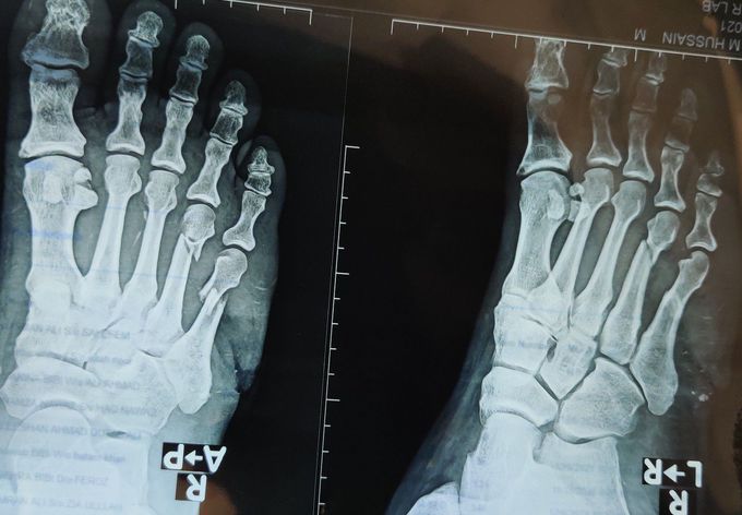 Fracture 4th and 5th Metatarsals