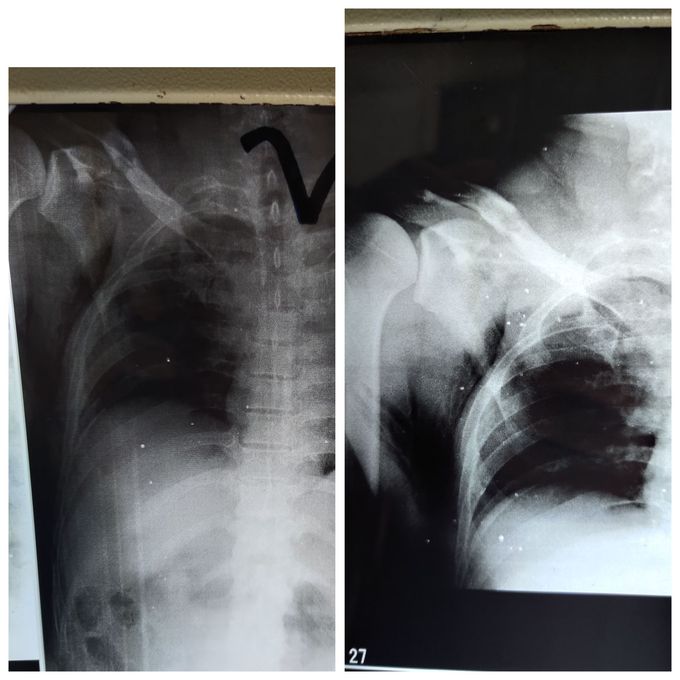 Hydropneumothorax after RTA