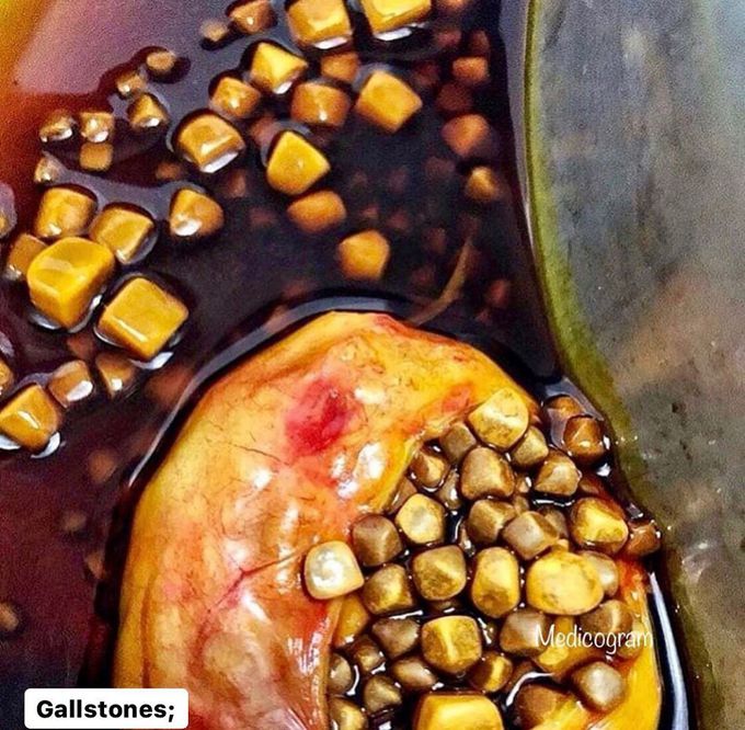 Here's a gallbladder full of stones!
