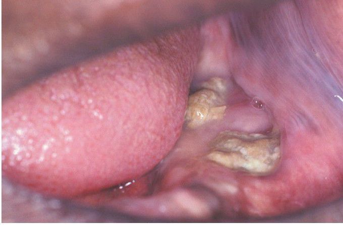 Florid Cemento-Osseous Dysplasia.