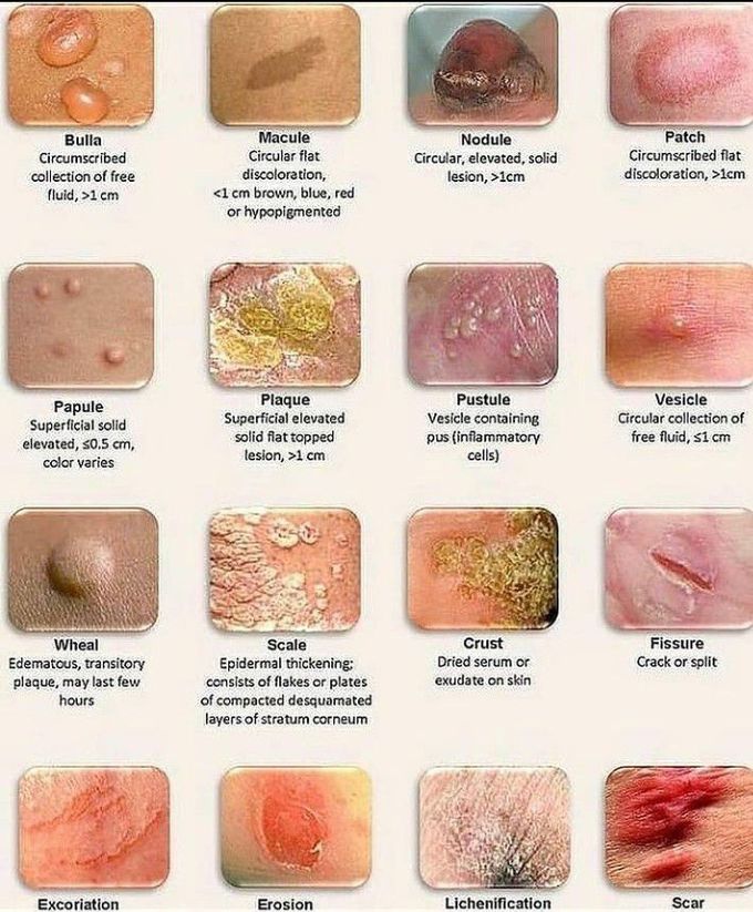 Different types of skin lesions