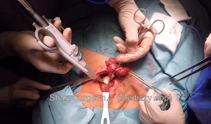 Thyroidectomy Surgery 🔪