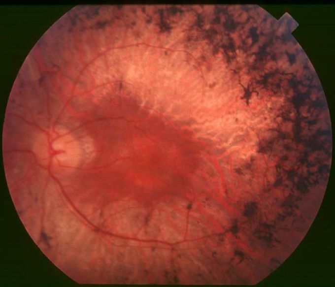 What causes retinitis pigmentosa