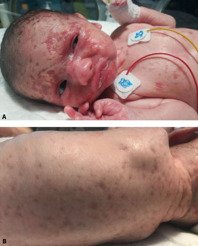 NEONATAL LUPUS