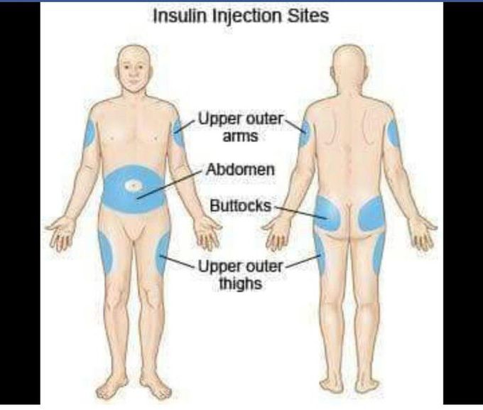 Insulin injection sites💉💉