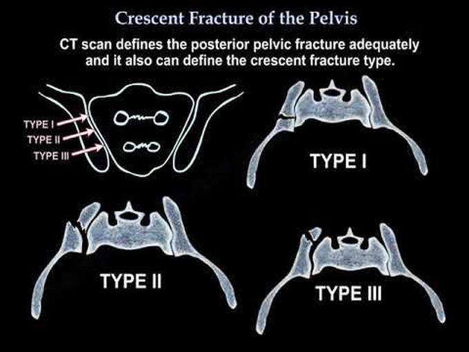 Crescent Fracture Of The Pelvis - Everything You Need To Know 