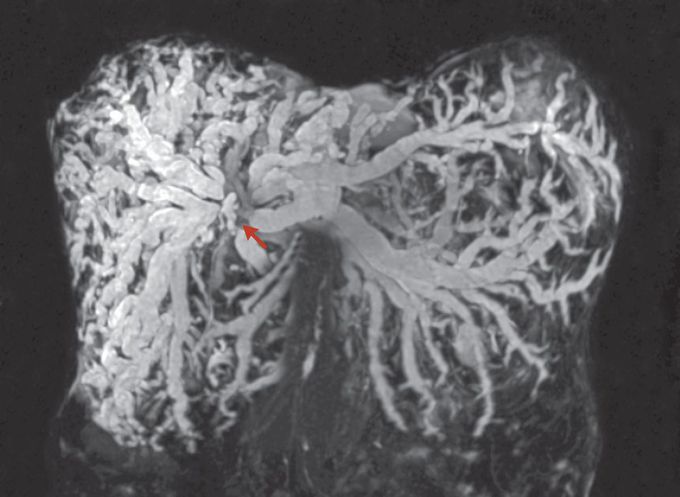 Intrahepatic Biliary Ductal Dilatation