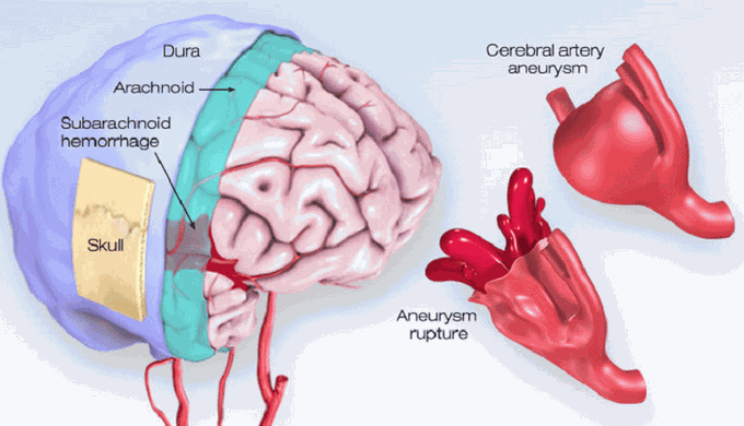 Brain aneurysm