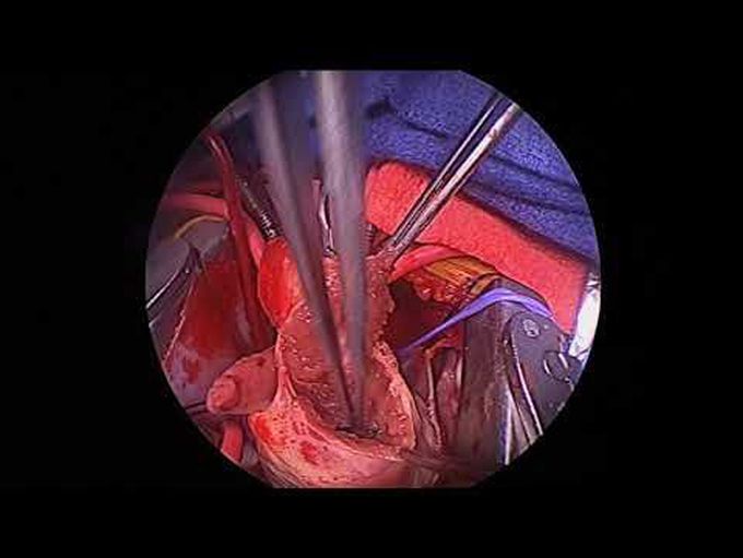 Nikaidoh Procedure