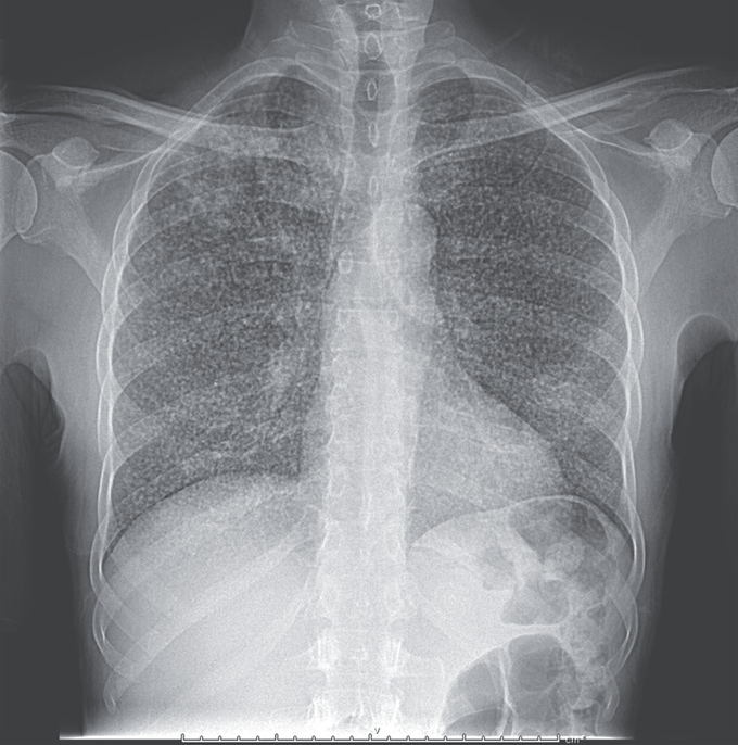 Case Of Miliary Tuberculosis In 56-Year-Old Male Patient