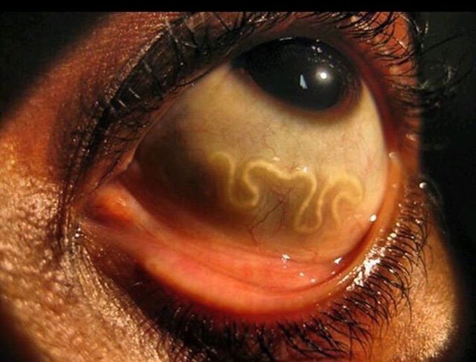 Loa loa filariasis
