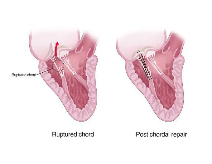 Mitral valve regurgitation treatment - MEDizzy
