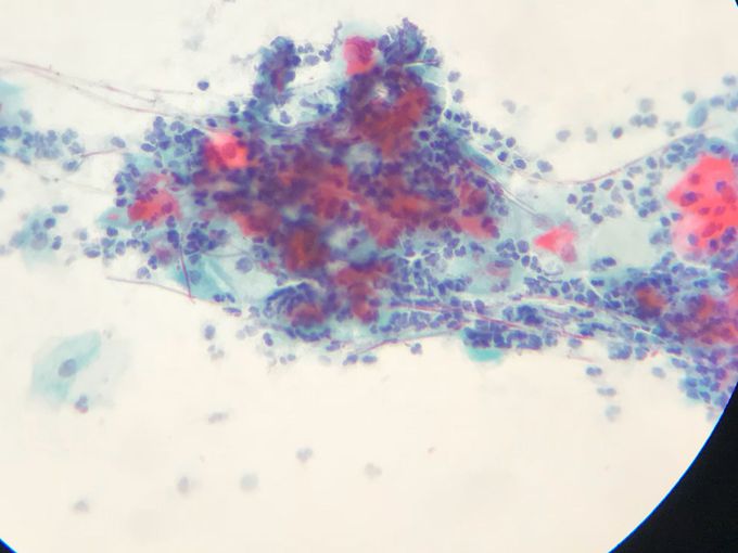 Candidiasis