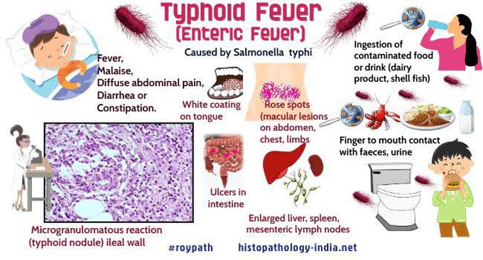 Symptoms of typhoid fever