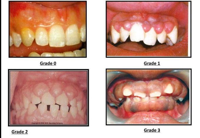 Grades of gingival enlargement