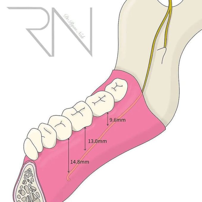 Lingual nerve