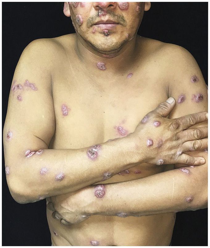 Disseminated Cutaneous Blastomycosis
