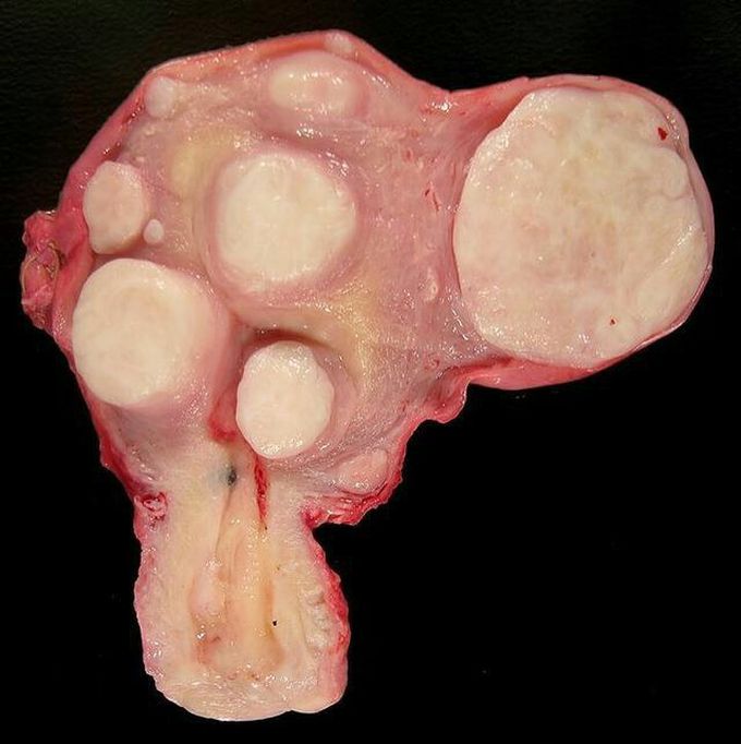 This is appearance of a uterus with multiple leiomyoma/fibroid tumors 