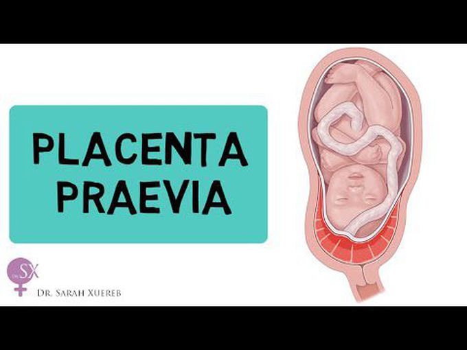 Placenta Previa