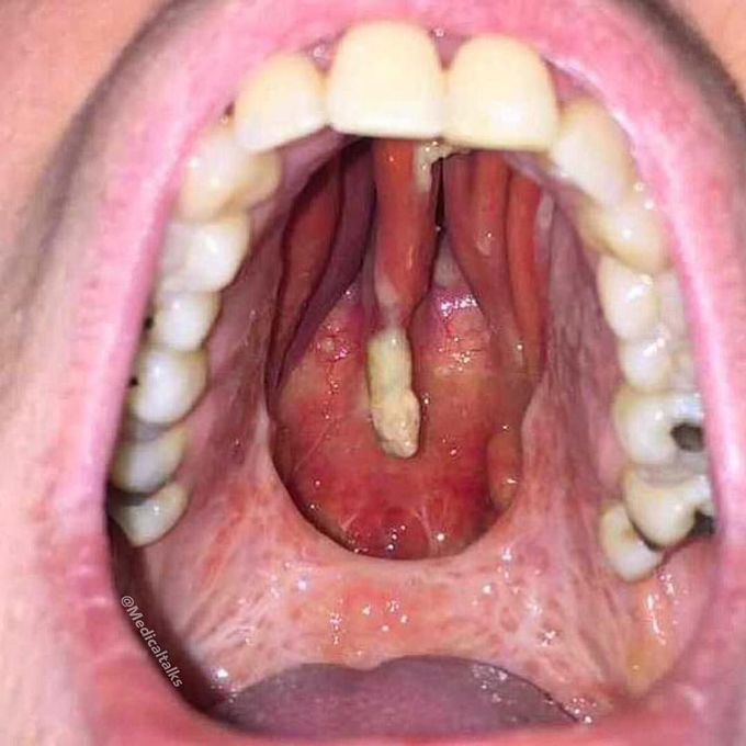 Snorting cocaine effect on hard palate erosion and perforation!  