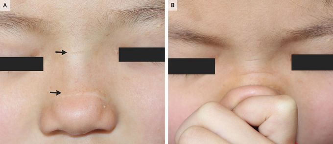 Transverse Nasal Creases