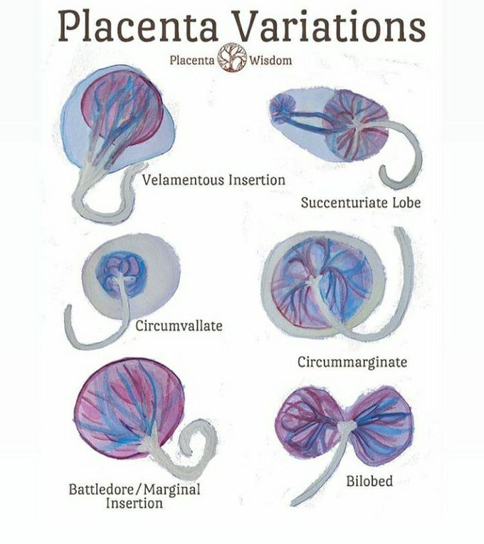 Abnormalities of placenta