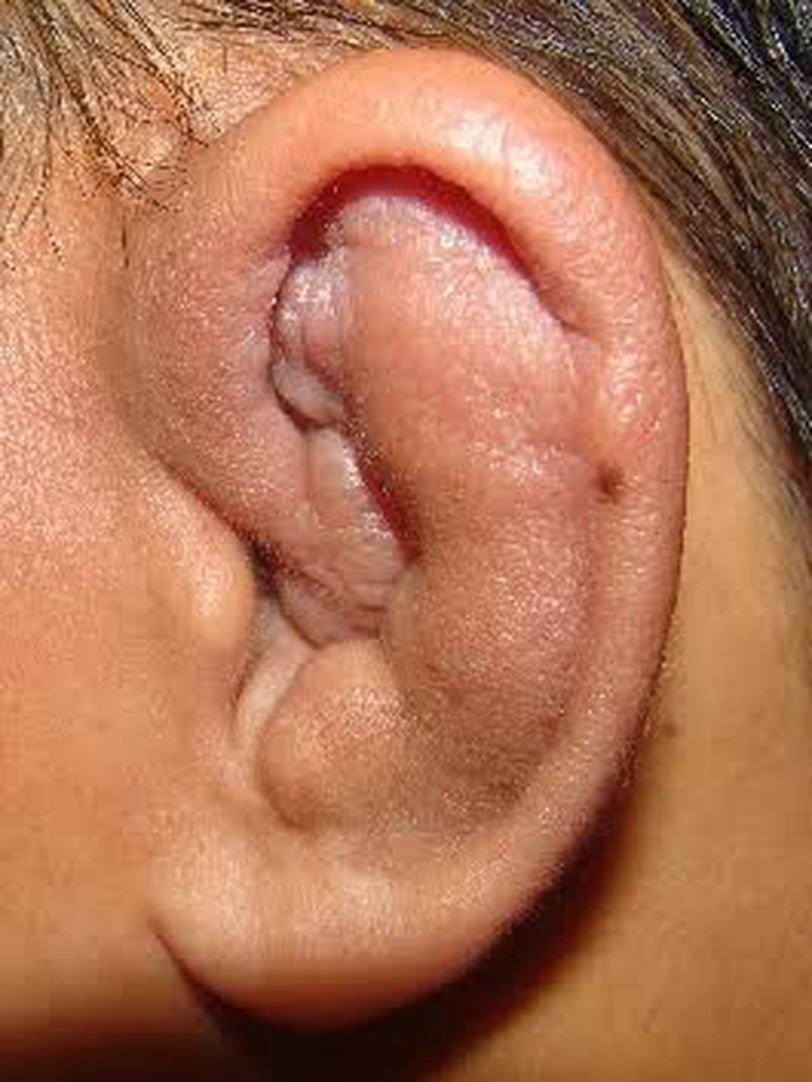 cauliflower ear