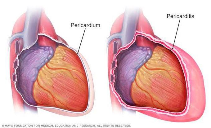 Symptoms of pericarditis