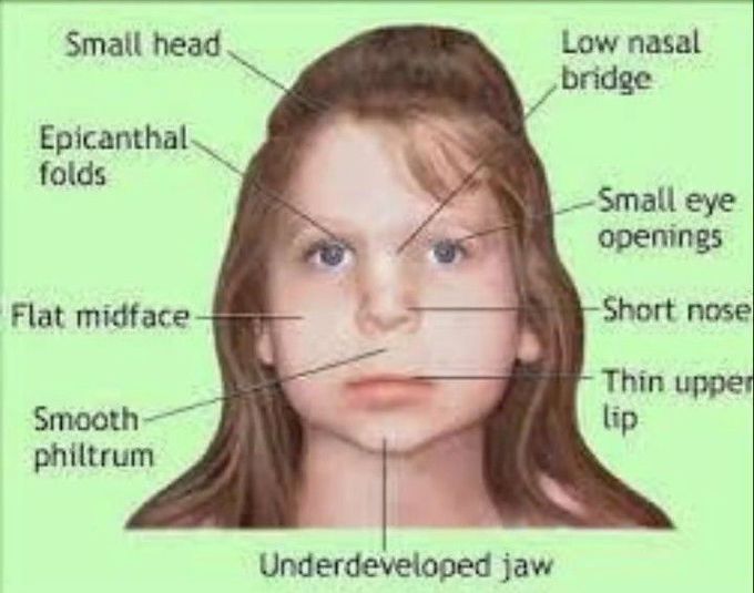 Features of DiGeorge Syndrome