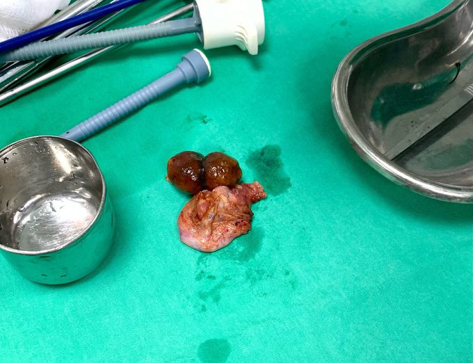 Gallstones