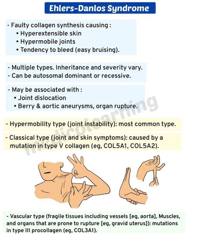 Ehler Danlos Syndrome
