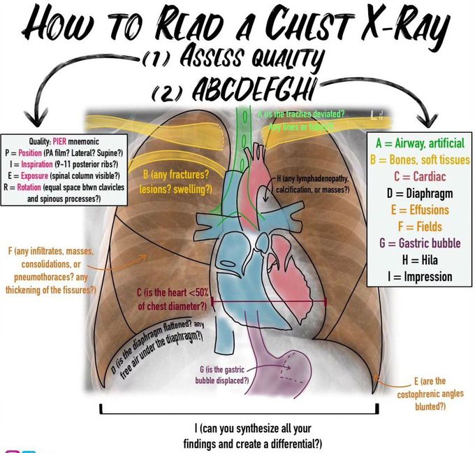 How to read the Chest X-ray
