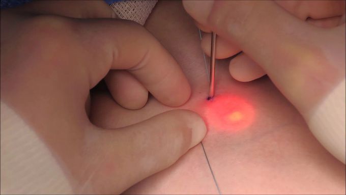 Single port Laparoscopic Inguinal Hernia Repair