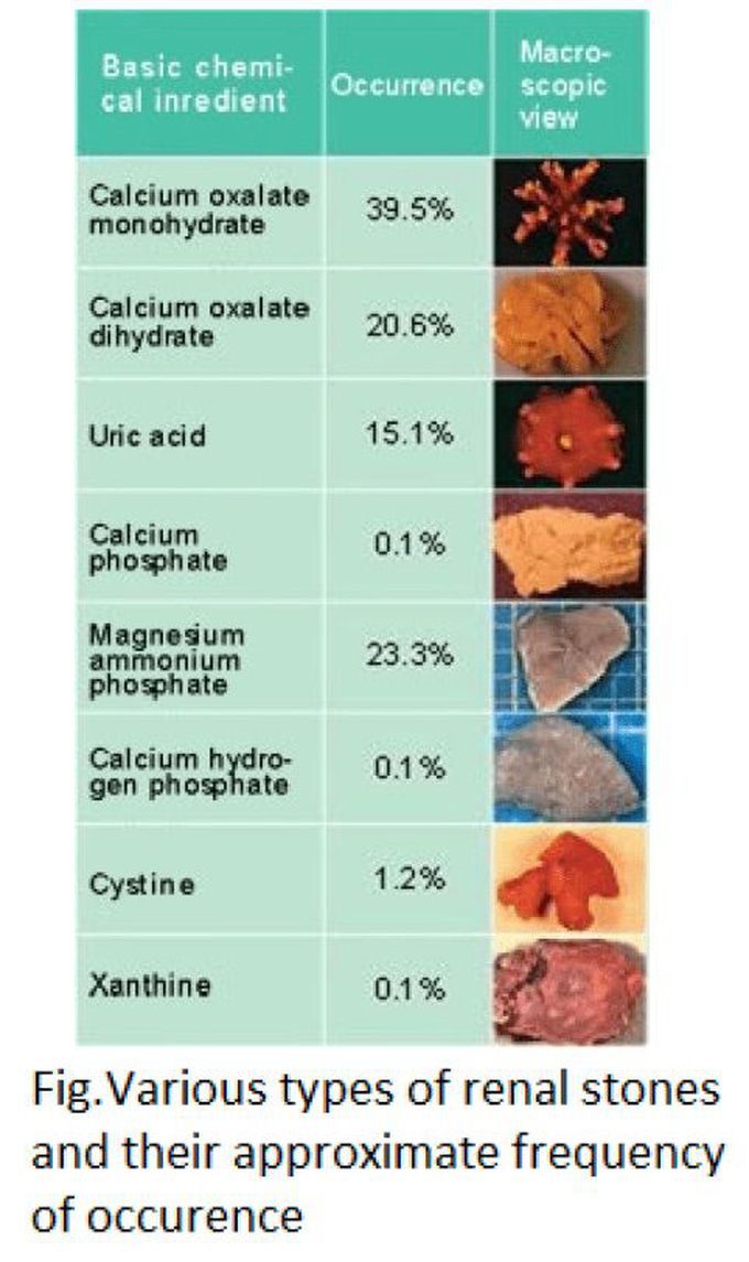 Renal calculus types