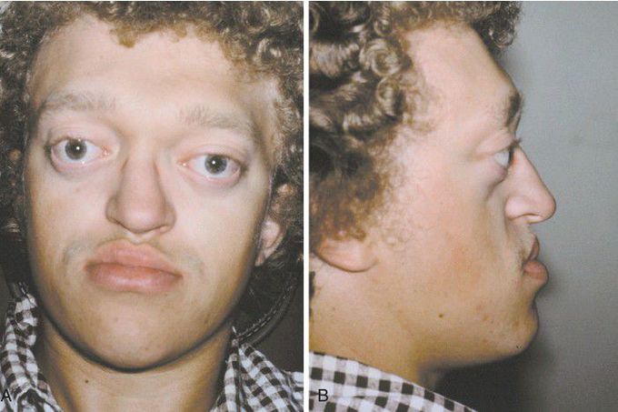 Characteristics Of A Baby With Fetal Alcohol Syndrome