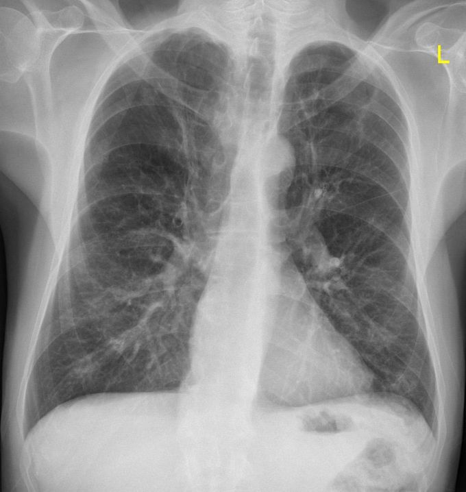 Emphysema