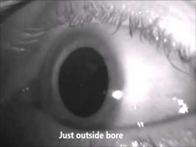 Nystagmus during MRI