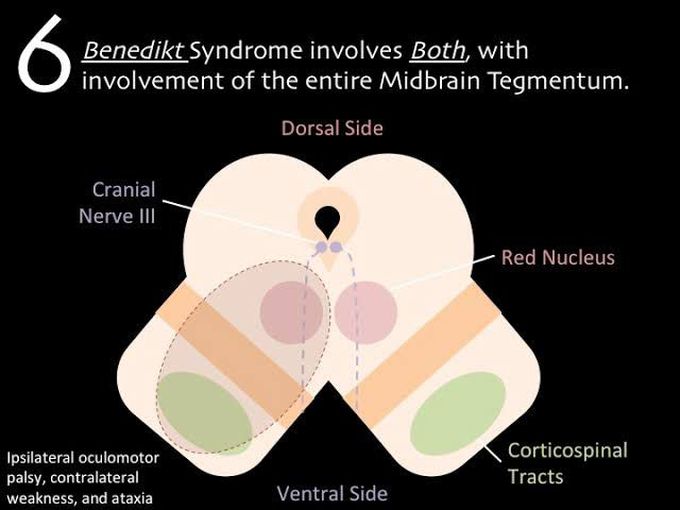 Symptoms of benedikt syndrome