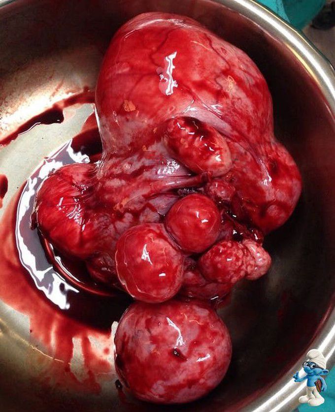 Multifibroid uterus after transabdominal hysterectomy